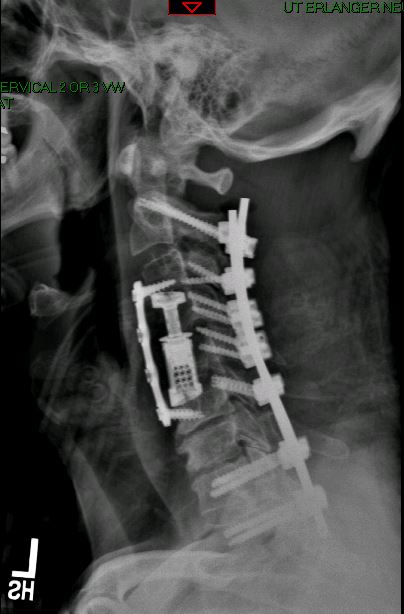 Cervical kyphosis with myelopathy — post-operative lateral X-ray