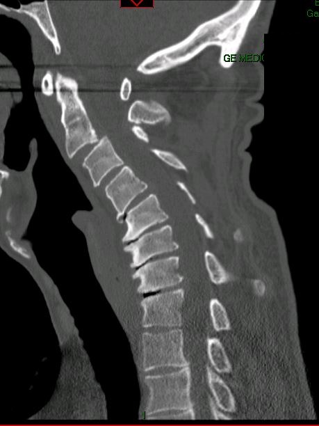 Cervical kyphosis with myelopathy — pre-operative CT sagittal showing bony anatomy and alignment