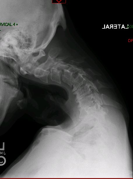 Cervical kyphosis with myelopathy — pre-operative lateral X-ray showing kyphotic deformity