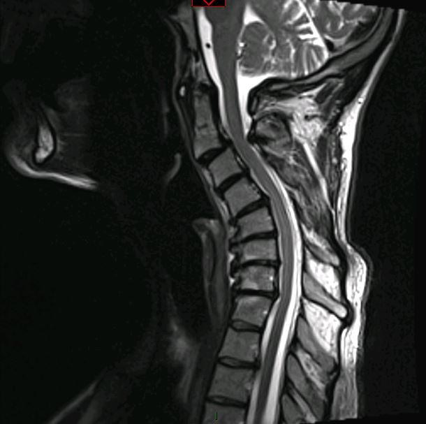 Cervical kyphosis with myelopathy — pre-operative MRI sagittal