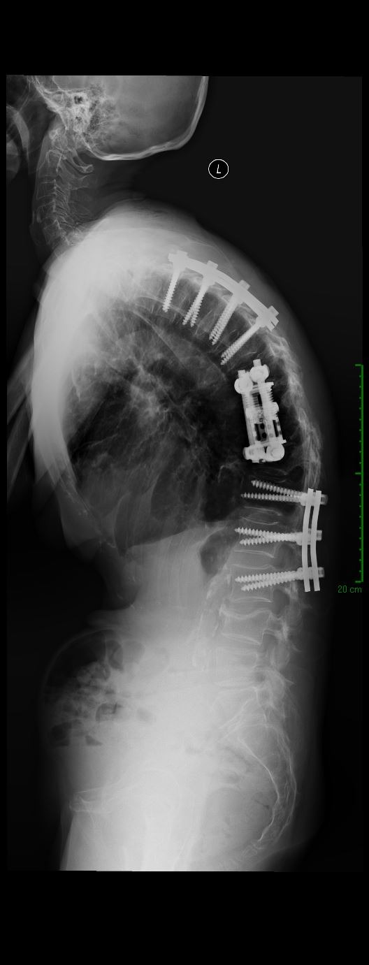 Failed back surgery with broken hardware — pre-revision lateral X-ray