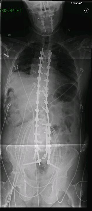 Sagittal imbalance and severe scoliosis — post-operative AP X-ray showing instrumented correction