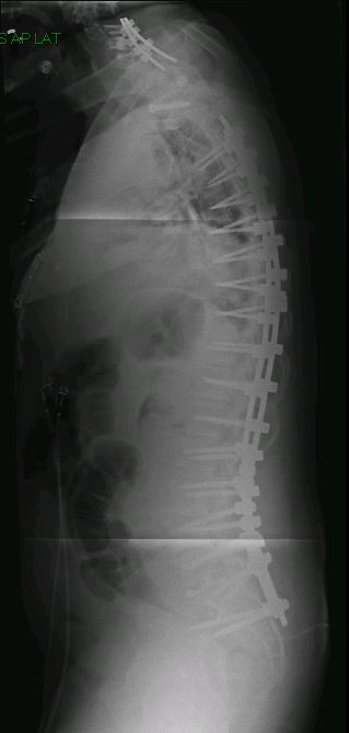 Sagittal imbalance and severe scoliosis — post-operative lateral X-ray