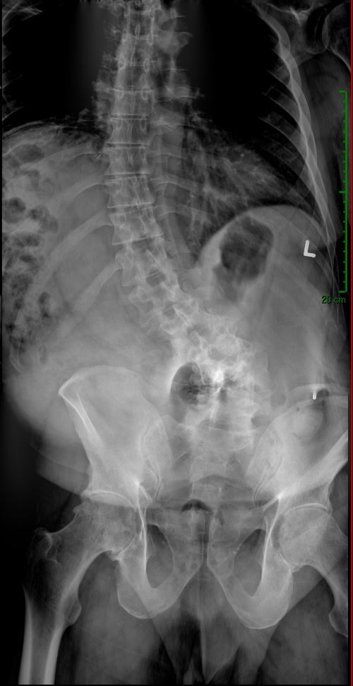 Sagittal imbalance and severe scoliosis — pre-operative AP X-ray full spine