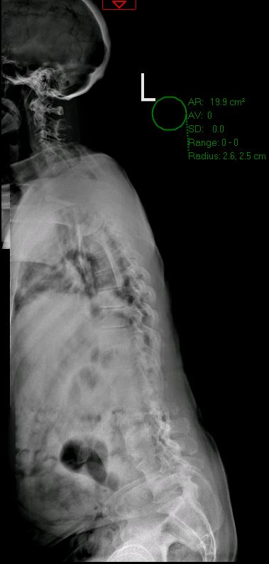 Sagittal imbalance and severe scoliosis — pre-operative lateral X-ray full spine